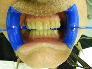 Patient A – after