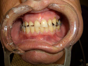 Denis – During Treatment (1)