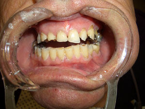 Denis – During Treatment (2)