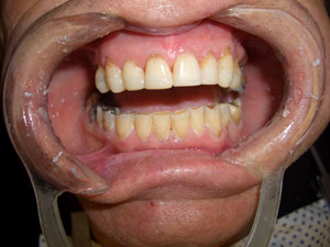 Denis – During Treatment (3)