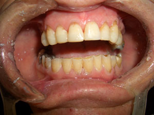 Denis – During Treatment (4)